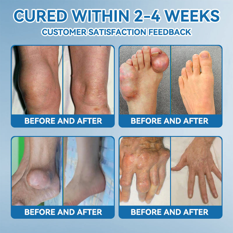 (Aeehfeng®) Only 10 boxes left! Enjoy an extra 30% off today! Clinically proven to relieve arthritis pain, stiffness, and inflammation—just 6 to 10 bottles can cure all types of arthritis. Don't wait another year—act now!